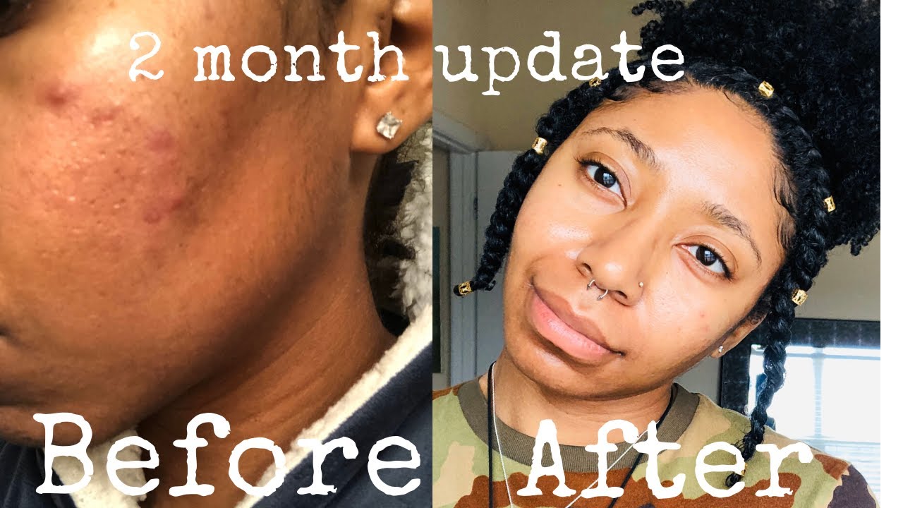 Urban Skin RX Clear Skin Bar 2 Month Review | Pictures Included | Ri's Remedies