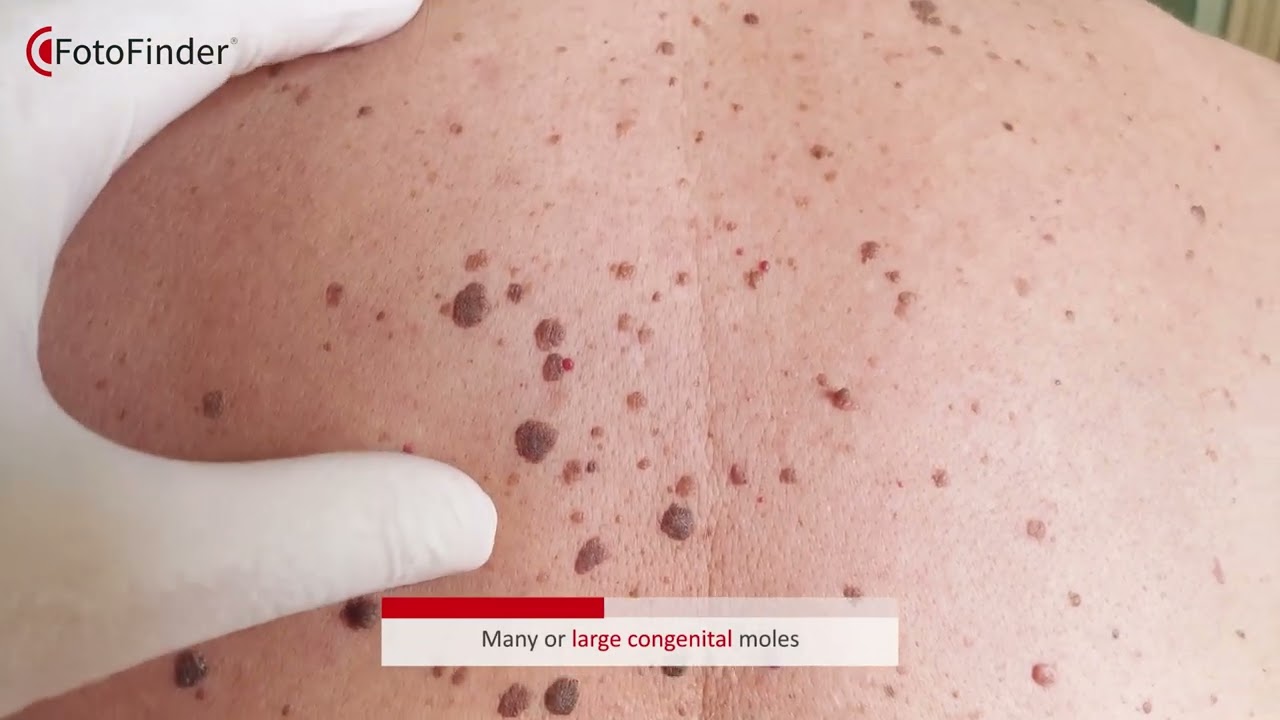 FotoFinder ATBM master Total Body Mapping [Waiting Room]