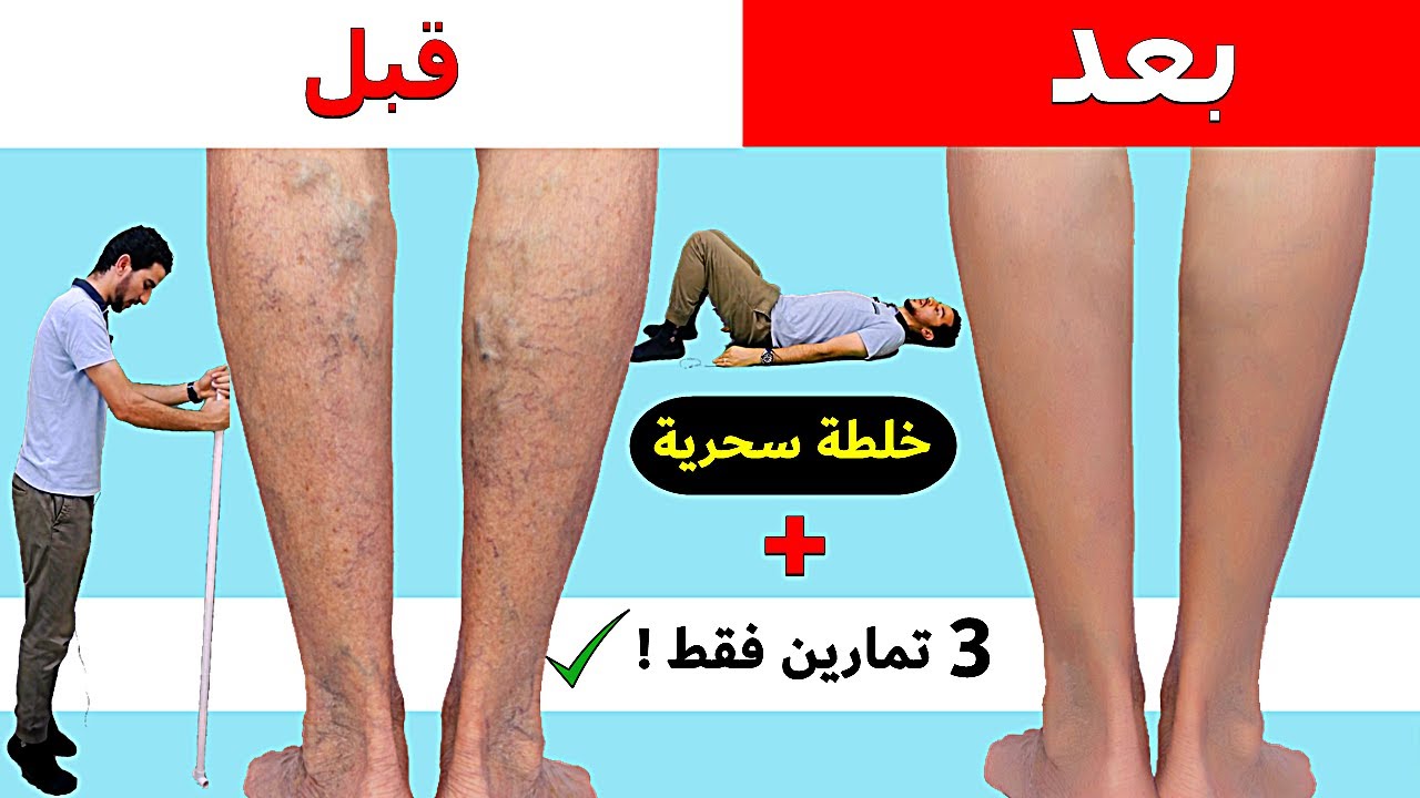 علاج دوالي الساقين مبكرا قبل الدخول في مرحلة الخطر ! التخلص من الاوردة العنكبوتية | د احمد الخطيب