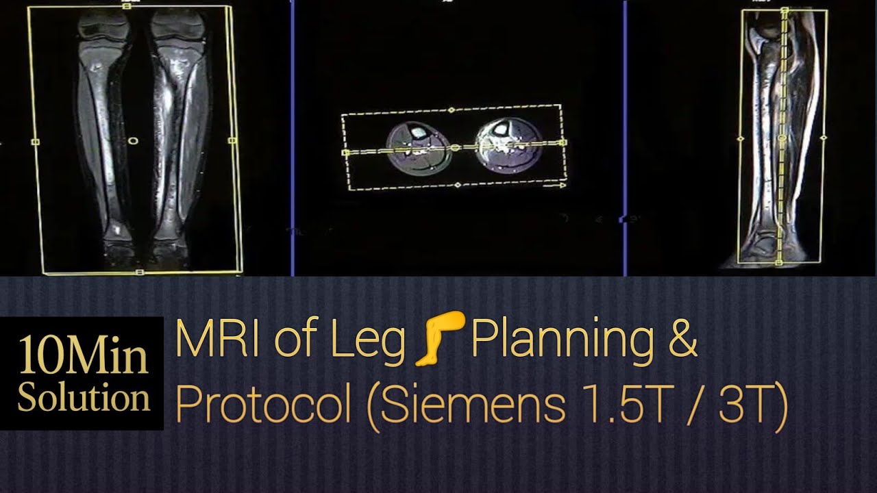 How to MRI of Leg Planning SIEMENS 1.5 T 3T MRA lower limbs planning