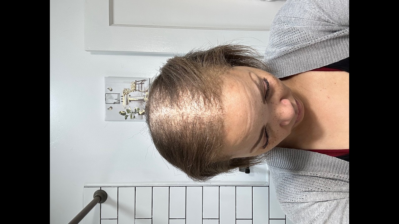 Beginning of my Hair Transplant Journey 