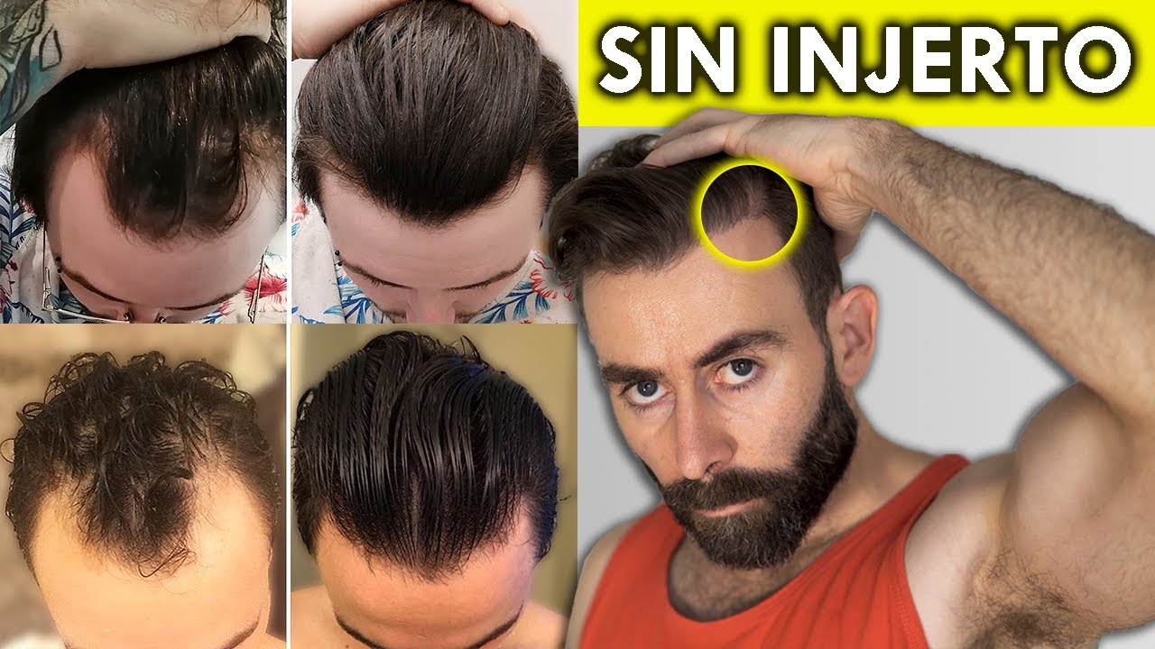 Descubre Cómo Recuperar El Pelo De Tus Entradas