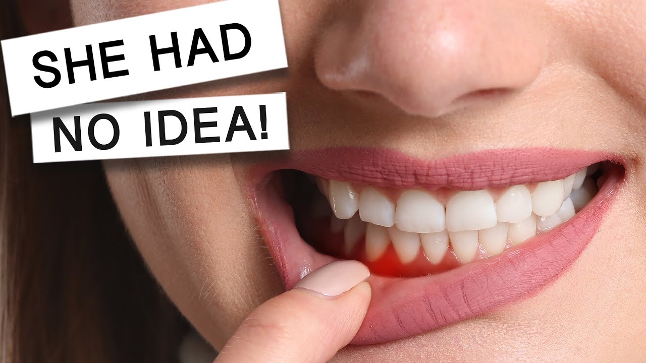 21 Year Old With Severe Gum Disease | Her Dentist Didn't Warn Her!