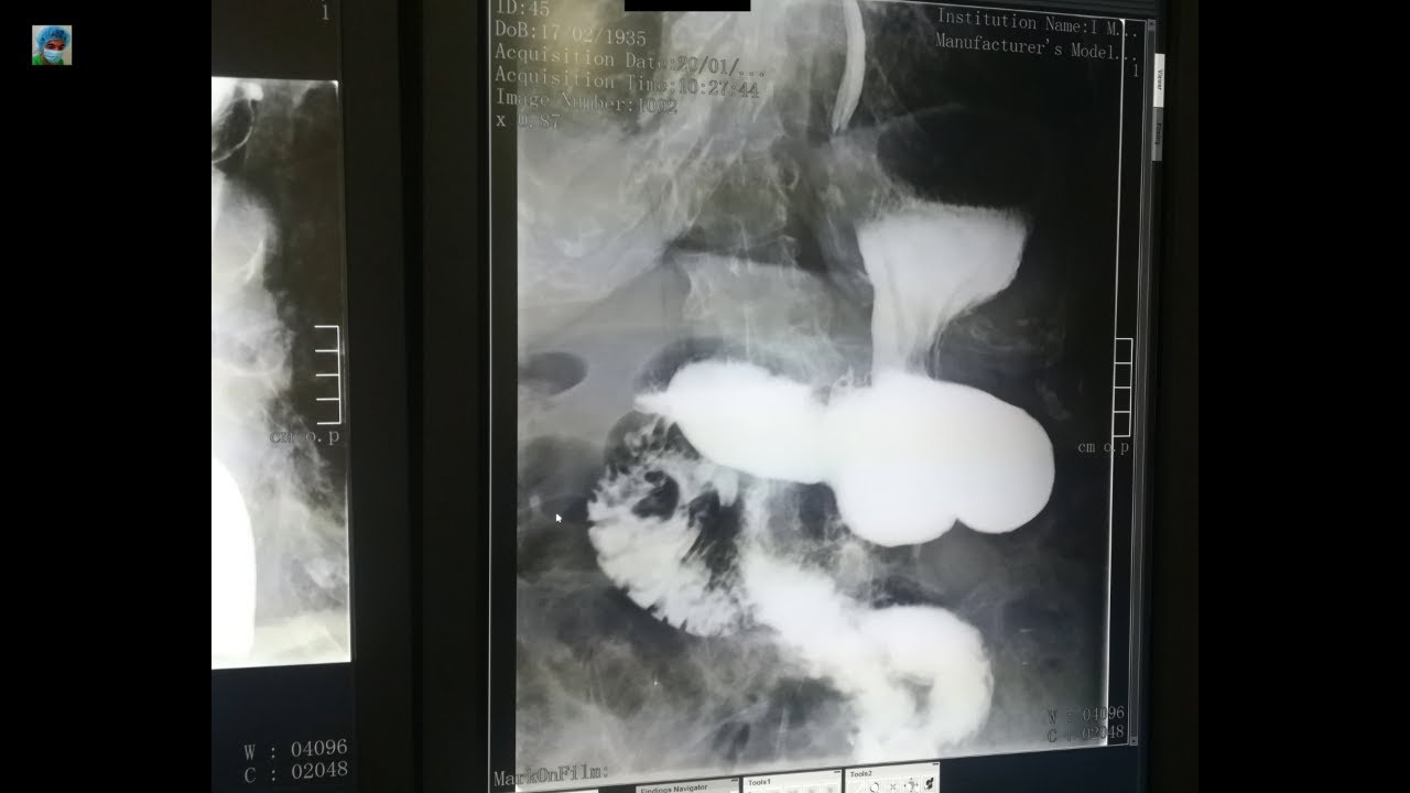 Radiology x ray cases online Library part 86 Esophagography Gastrography Irrigography Barium studies