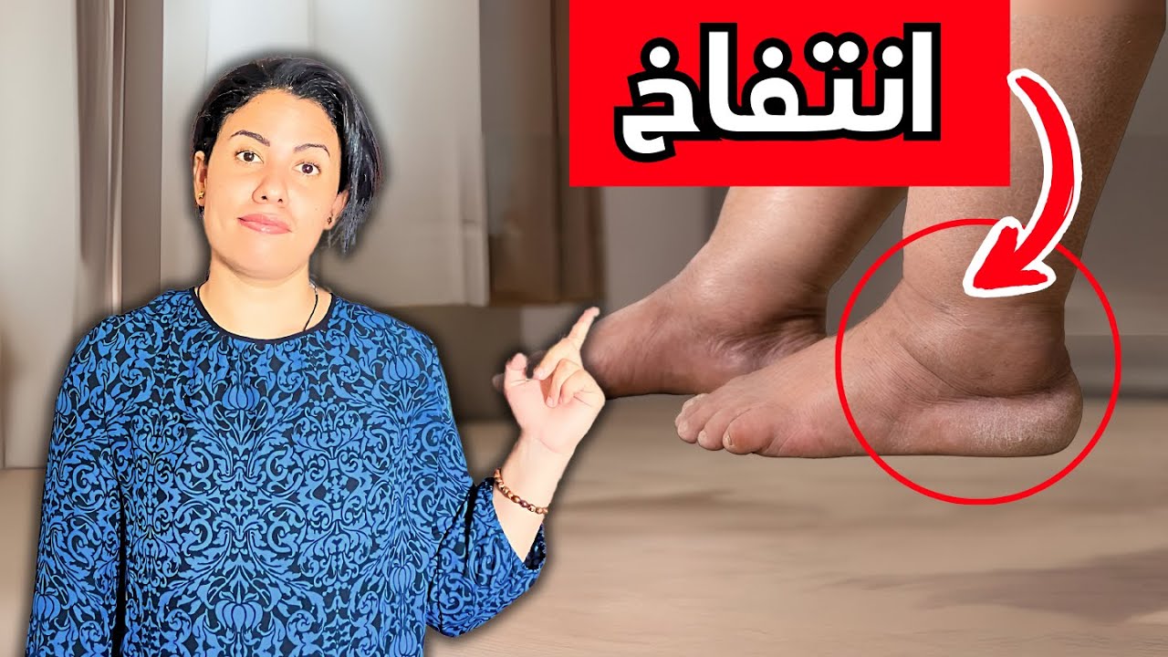 تخلص من تورم القدمين فورا بتقنية العلاج الطبيعي المضمونة والمُجرّبة