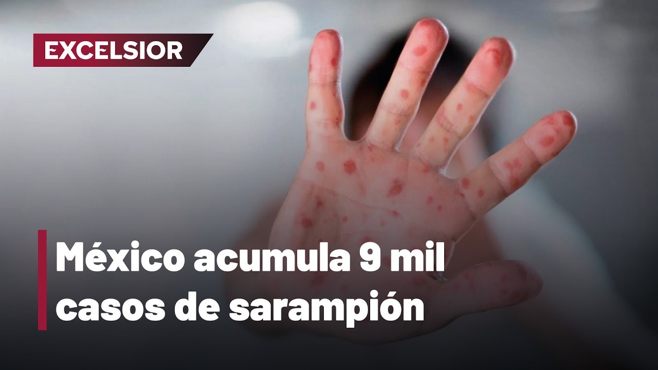 Brote de sarampi&oacute;n en M&eacute;xico: &iquest;Qu&eacute; estados son los &lsquo;focos rojos&rsquo; de la enfermedad?
