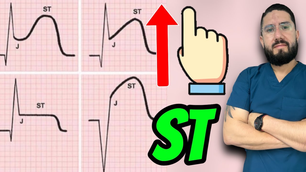 Electrocardiograma con elevación del ST 🫀