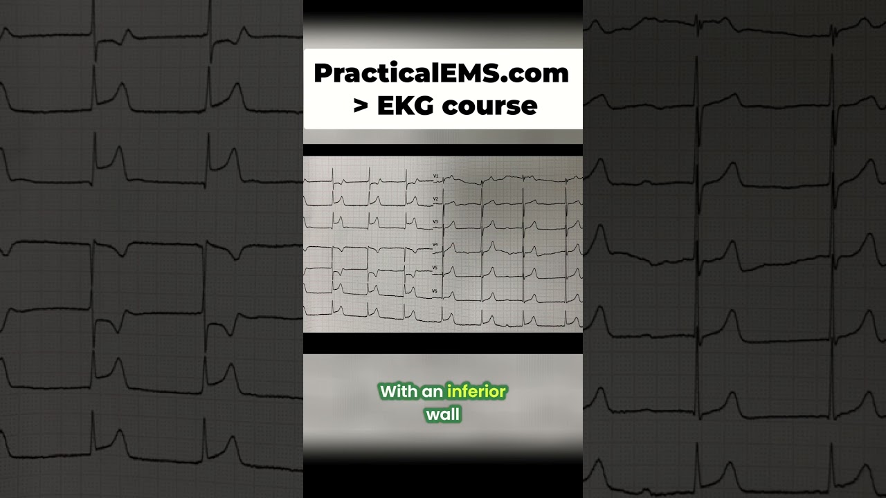 EKG Reveals Heart Attack: Spot the Signs & Save a Life! 