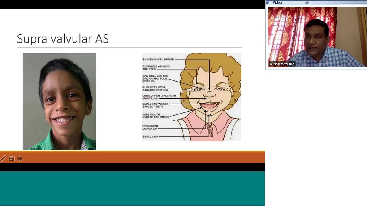 Aortic stenosis Dx and Rx incl Balloon valvuloplasty by Dr Nageswara Rao