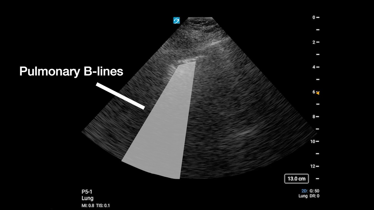 Point-of-Care Ultrasonography of Pulmonary B-Lines
