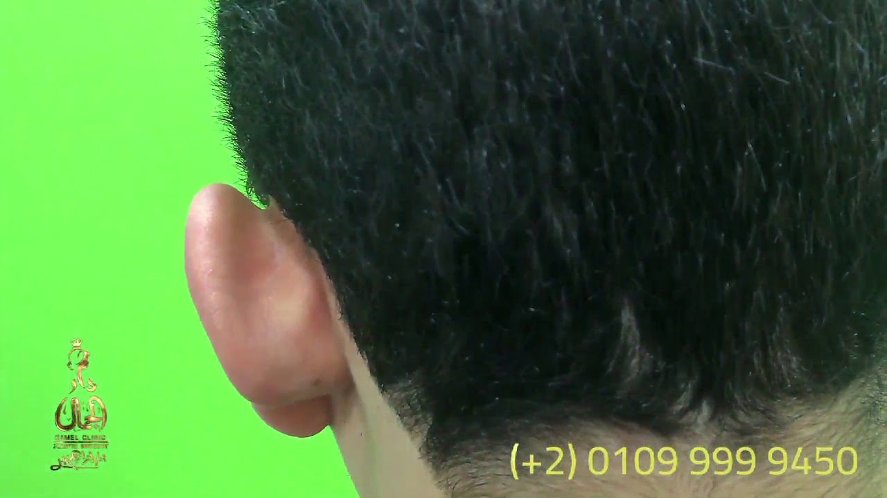 ear surgery - otoplasty - Egypt  - Ibrahim KAMEL -Dar eljamal