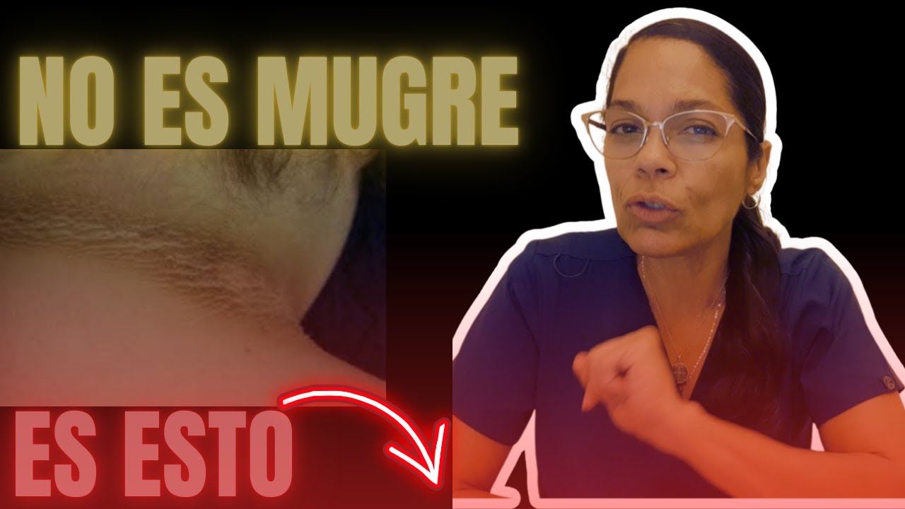¿Tiene el CUELLO NEGRO? 😱 No es suciedad: Signo de Resistencia a la Insulina