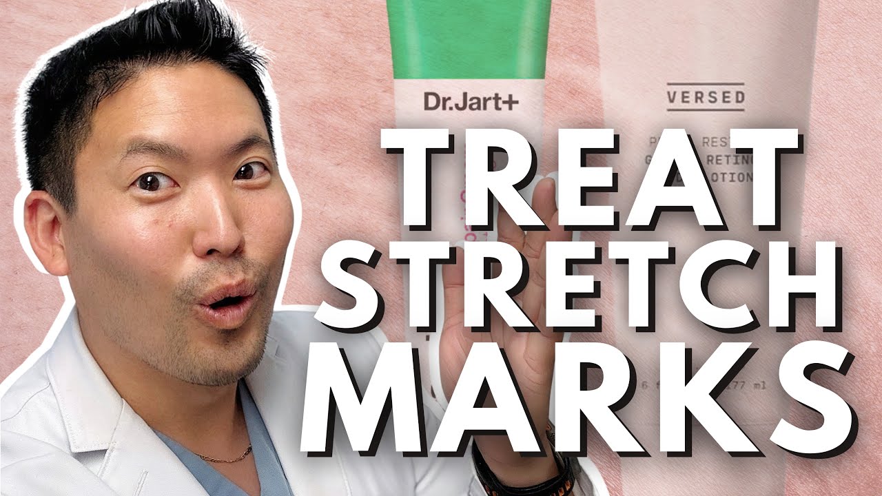 Evidence Based Ways to Treat Stretch Marks