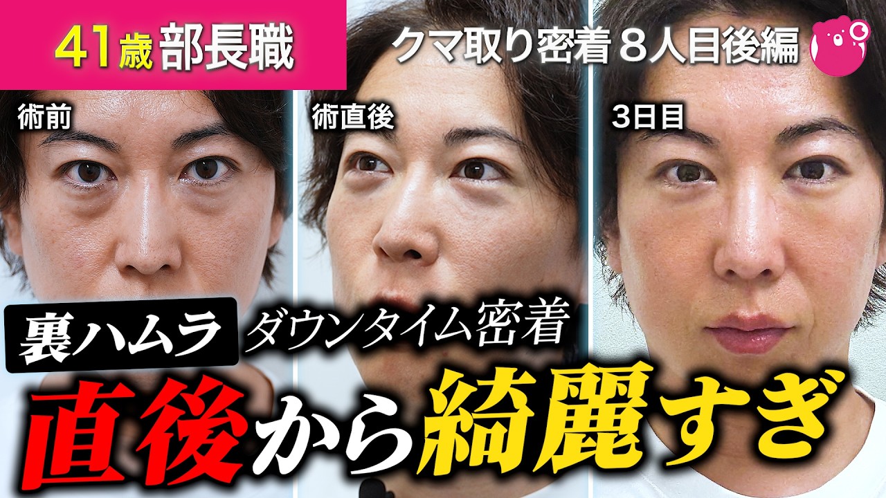 【裏ハムラ】40代男性のクマ取りダウンタイム1ヶ月後まで全て公開！直後から感動の仕上がり【クマ取り密着8人目後編】#裏ハムラ#クマ取り#美容整形 #湘南美容クリニック #ダウンタイム