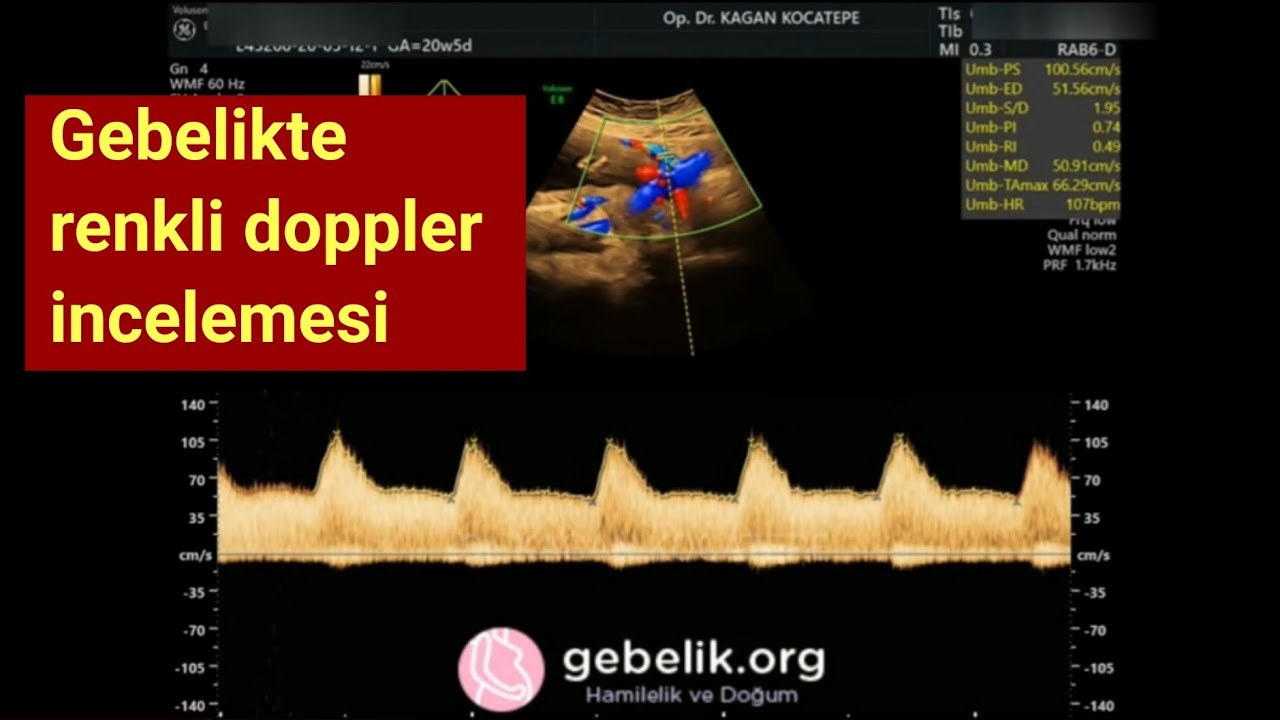 RENKLİ DOPPLER NASIL VE NEDEN YAPILIR,UTERİN ARTERDE ÇENTİK (NOTCH) VE DİRENÇ ARTIŞININ RİSKİ NEDİR?