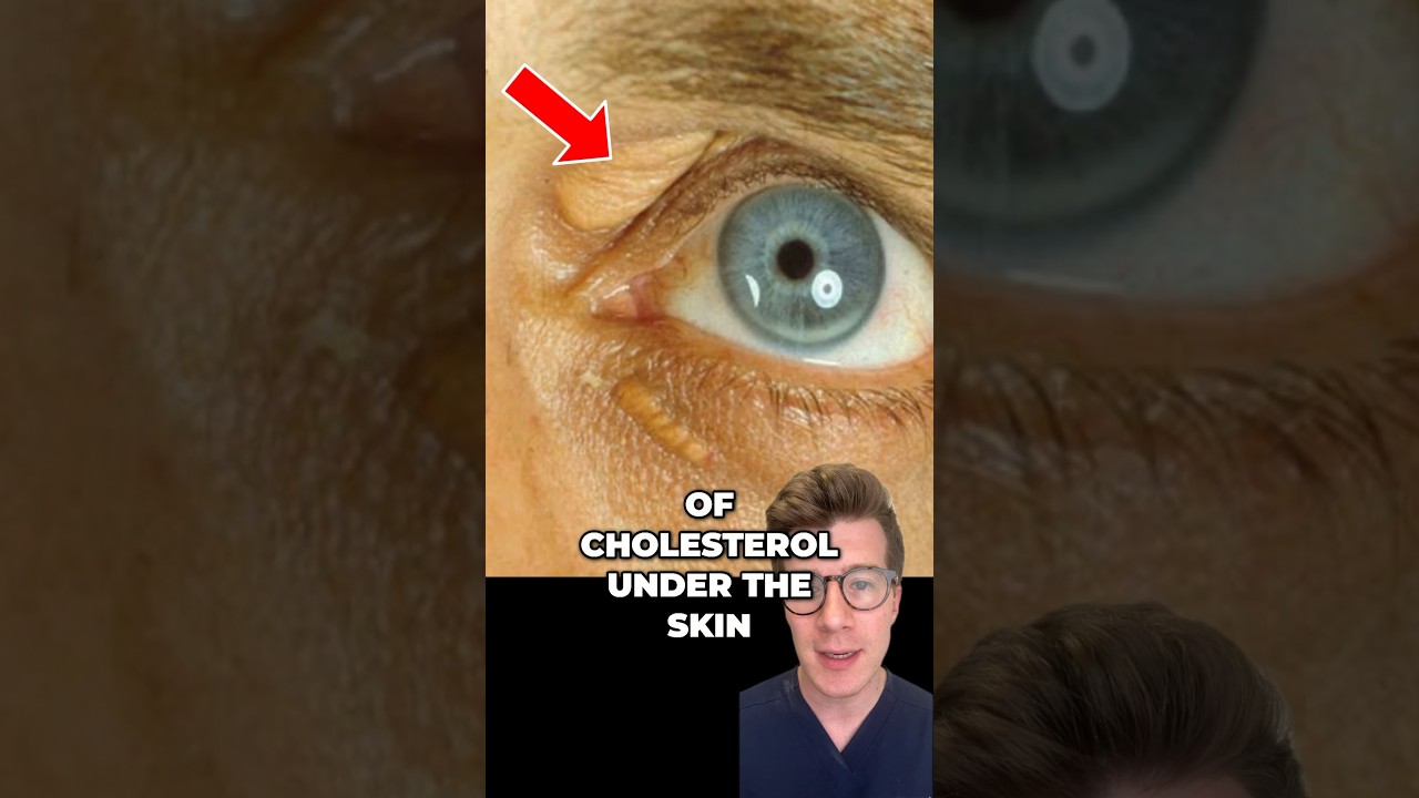 3 signs of HIGH CHOLESTEROL #shorts #health #cholesterol