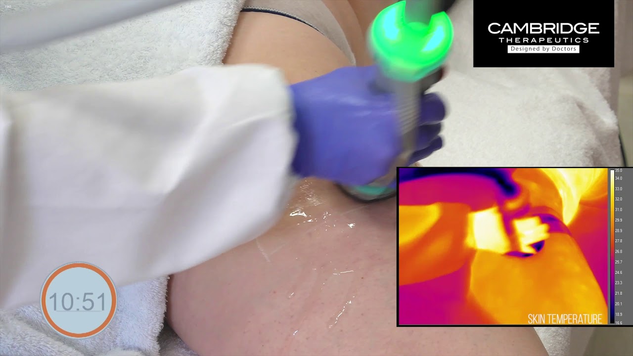 ONDA Coolwaves™ Cellulite Treatment