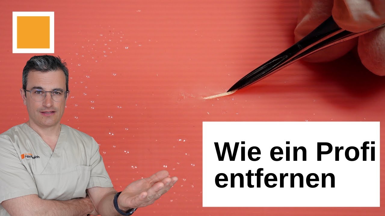 Holzsplitter entfernen im Fu&szlig; oder anderswo - Hautarzt erkl&auml;rt - Dr. Kasten Hautmedizin in Mainz