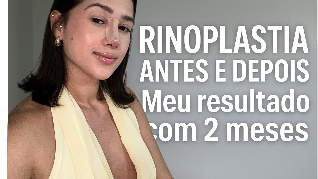 Tudo sobre minha rinoplastia: processo, recuperação e resultado