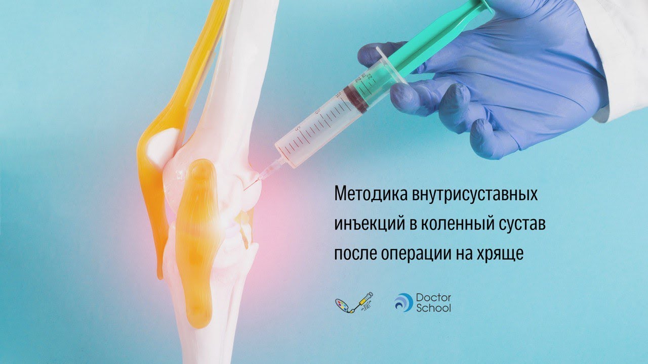 Методика внутрисуставной инъекции в коленный сустав после операций на хряще