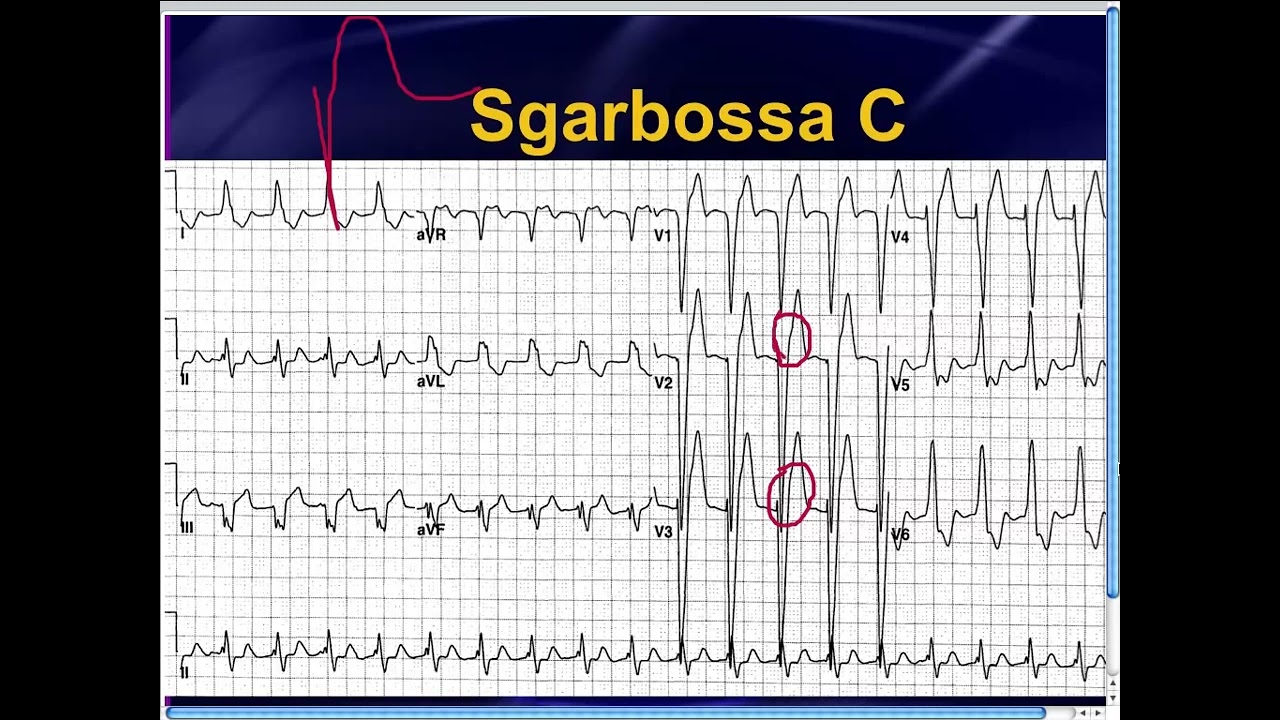 Amal Mattu's ECG Case of the Week_ Nov 4, 2013