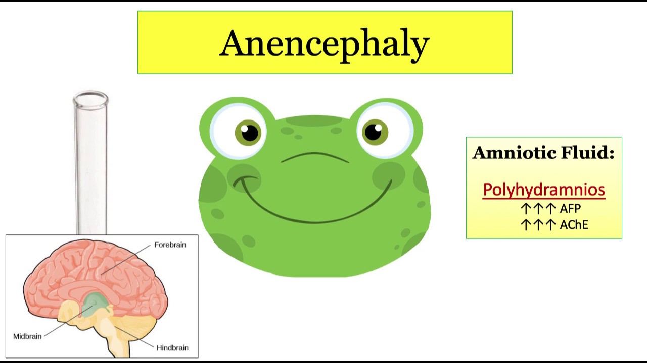 12DaysinMarch, Congenital Neuro Abnormalities Part 1 for the USMLE Step One Exam