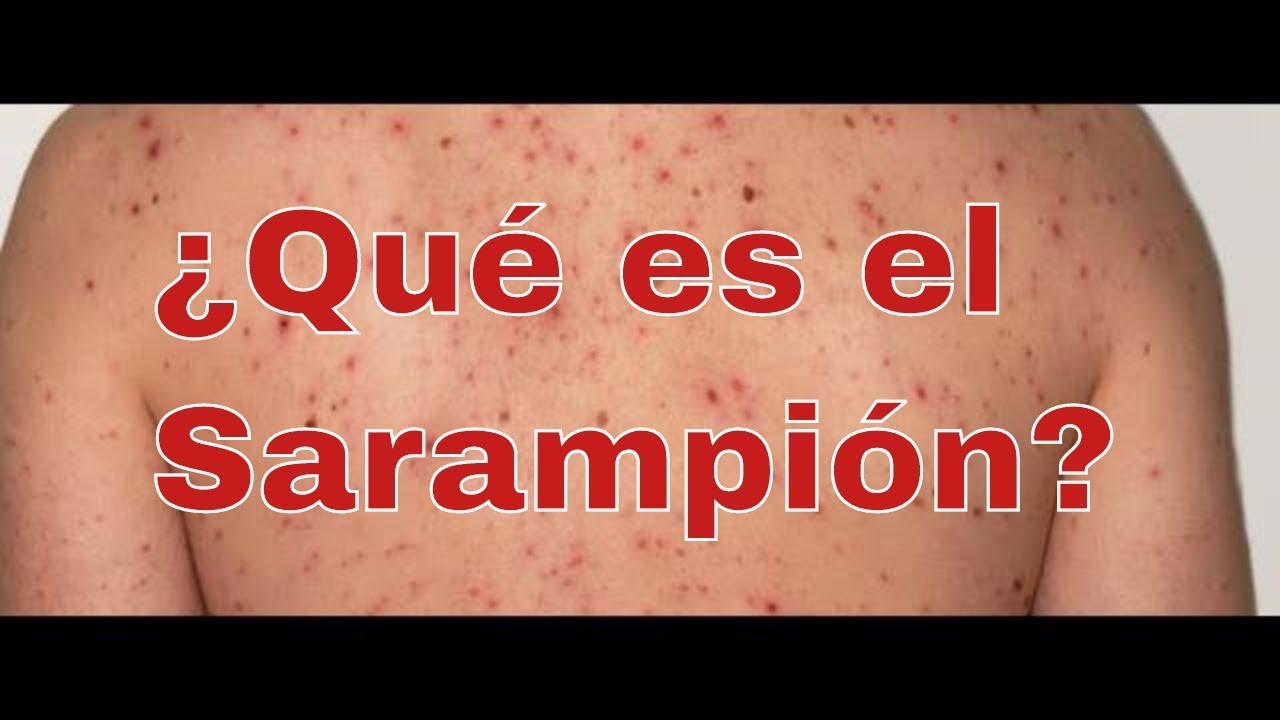 ¿Qué es el Sarampión?