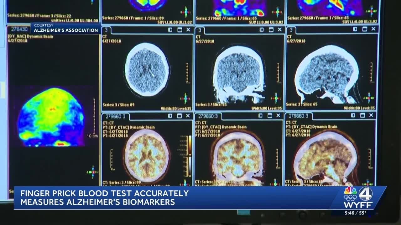 Upstate experts celebrate milestone in Alzheimer's, dementia research