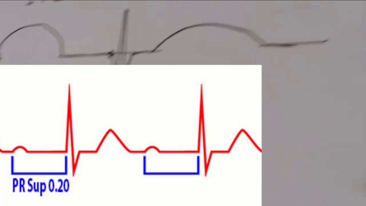 ECG Interpretation tres facile de l ECG 13eme partie Les troubles de conduction