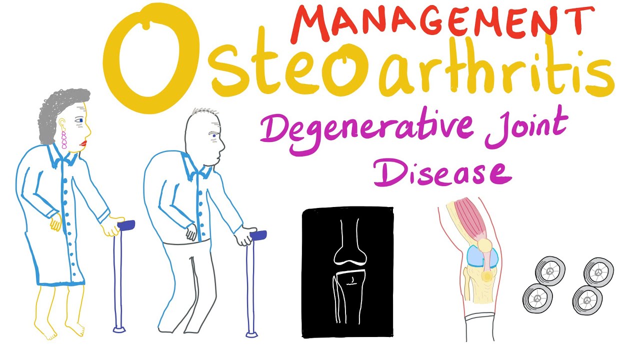 Osteoarthritis (OA) - Treatment -  Degenerative Joint Disease - Rheumatology Series