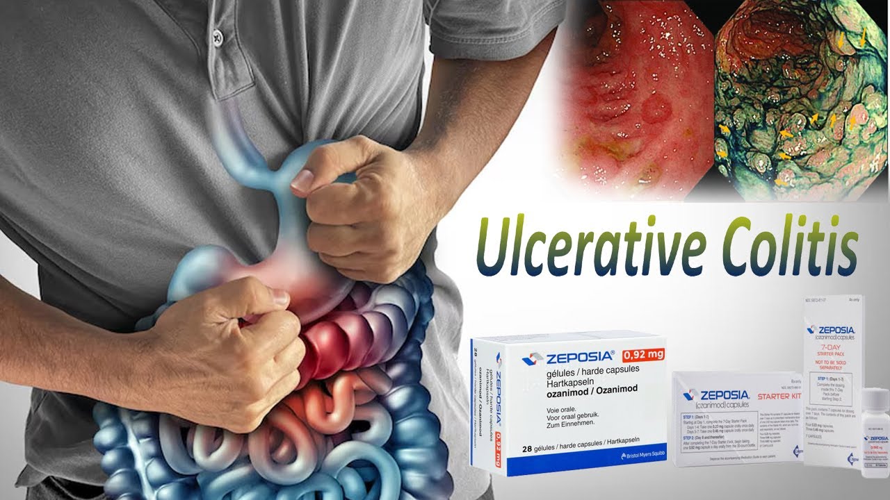 Zeposia | Ulcerative colitis - causes, symptoms, diagnosis, treatment, pathology | Medications