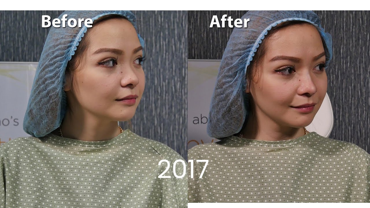Y-KO MULTI COG NONSURGICAL NOSE LIFT