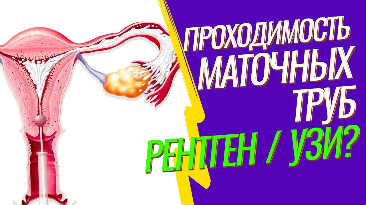 ГИСТЕРОСАЛЬПИНГОГРАФИЯ (ГСГ маточных труб) 🚩 Проверить проходимость труб