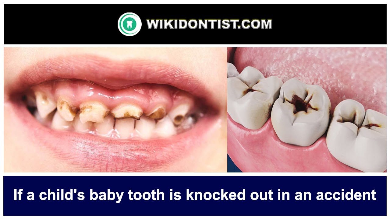 If a child's baby tooth is knocked out in an accident ... Video by Dr.Thomas Nechupadam