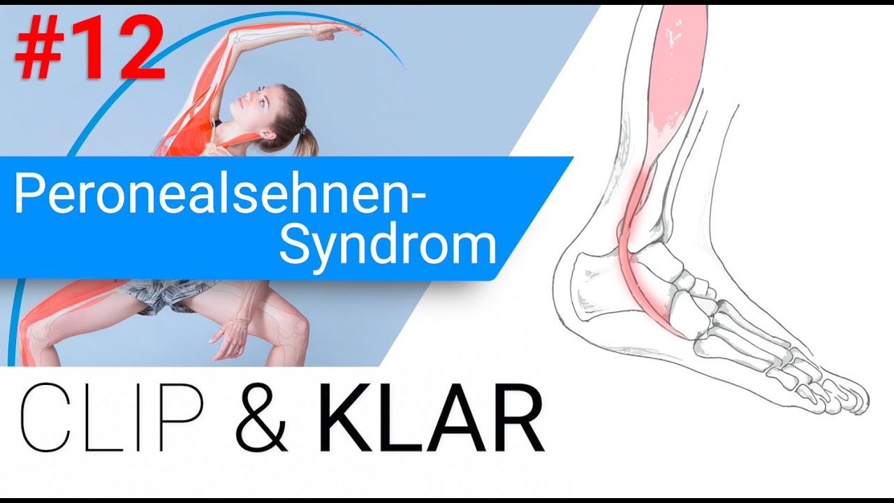 Peronealsehnen-Syndrom erkl&auml;rt - Sehnensch&auml;digung am Fuss-Aussenkn&ouml;chel