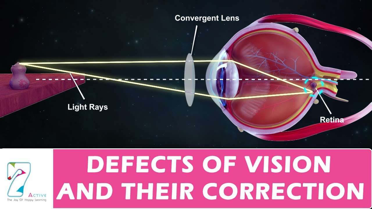 DEFECTS OF VISION AND THEIR CORRECTION
