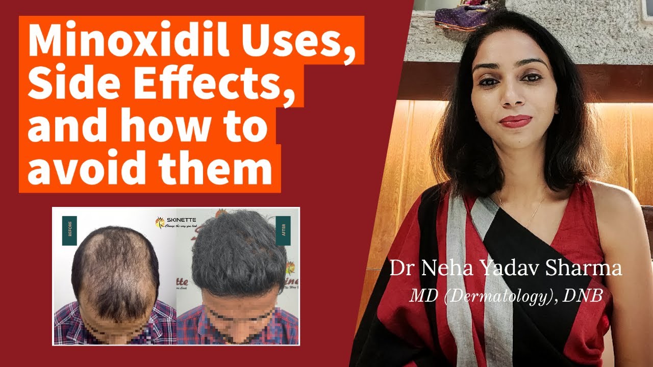 MINOXIDIL for Hair Regrowth & Hair Loss Treatment: Topical Uses, SIDE EFFECTS & WARNINGS [2022]