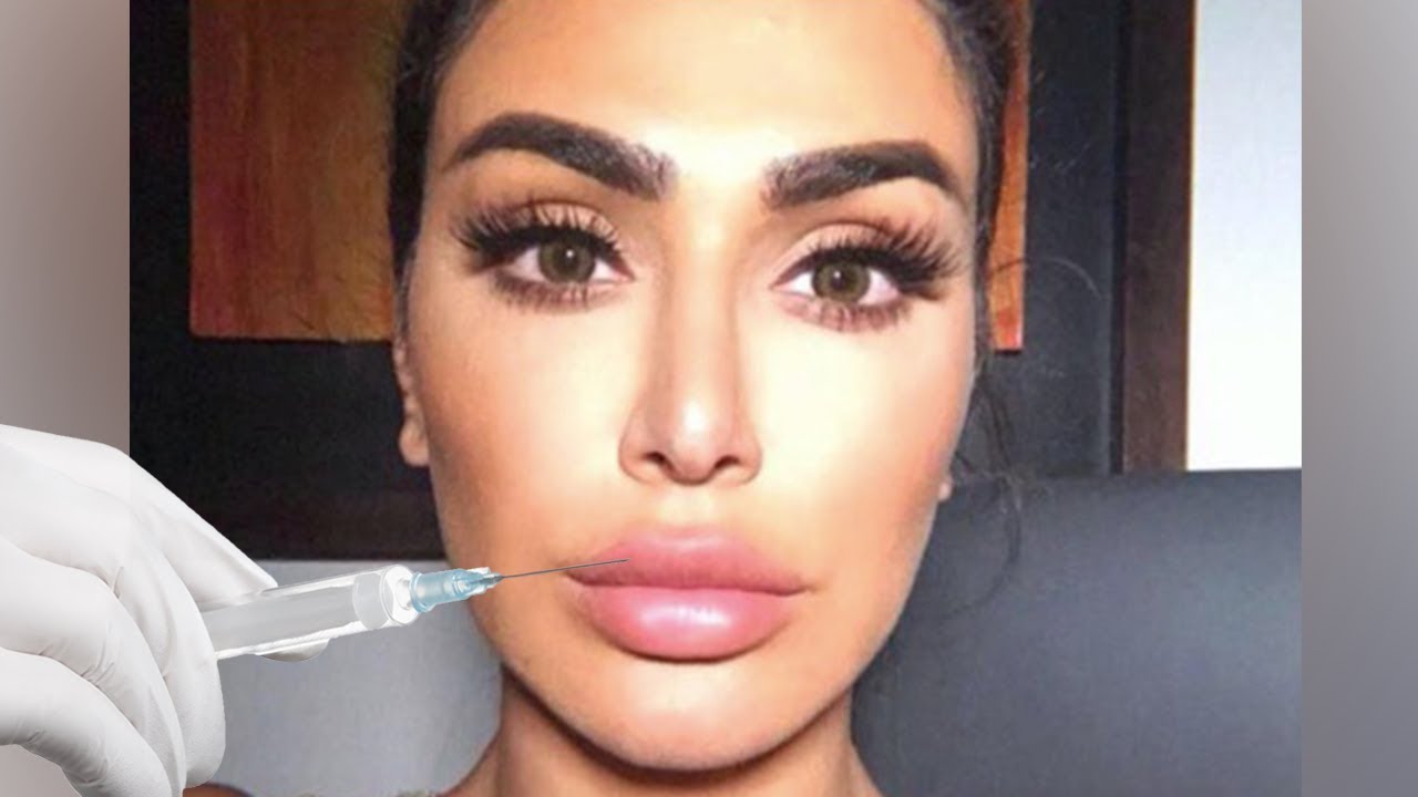 My Lip Filler (Horror) Story!| حكايتي المرعبة مع نفخ الشفاه