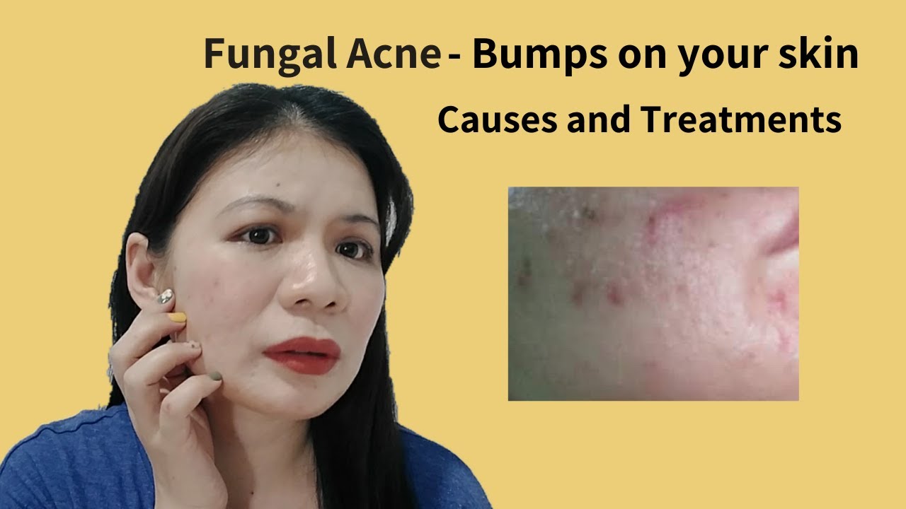 Fungal Acne Treatments and Safe Products