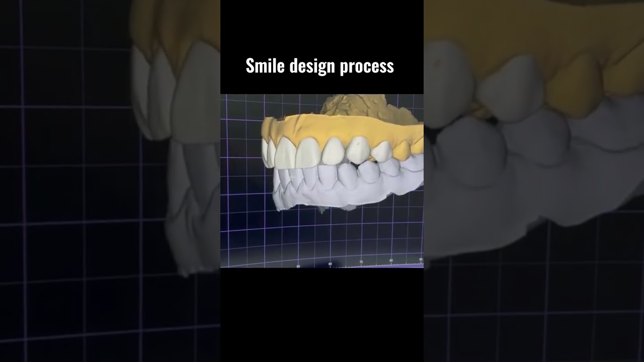 Smile design process with digital dentistry