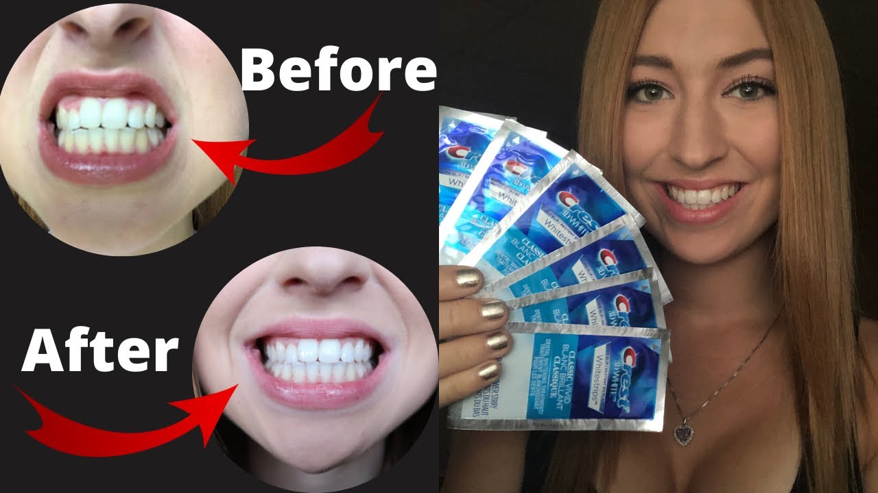 Crest 3D White Strips! REVIEW (great results!)