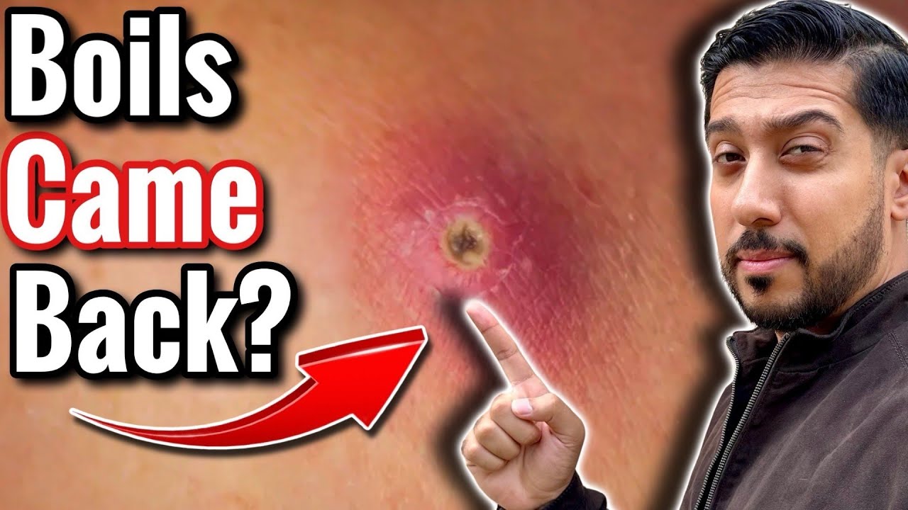 Boils Keep Coming Back, What to Do? | Stop Recurring Boils NOW