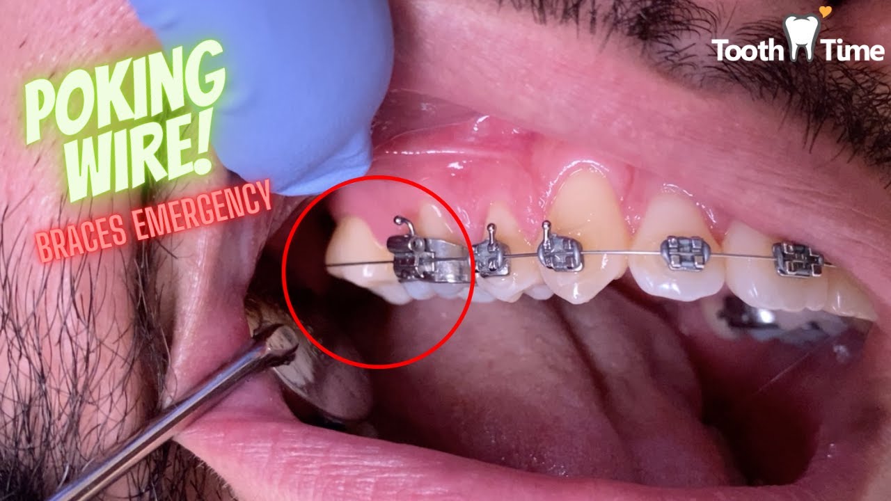 Braces Emergency - What to do if you have a Poking Wire - Tooth Time Family Dentistry New Braunfels