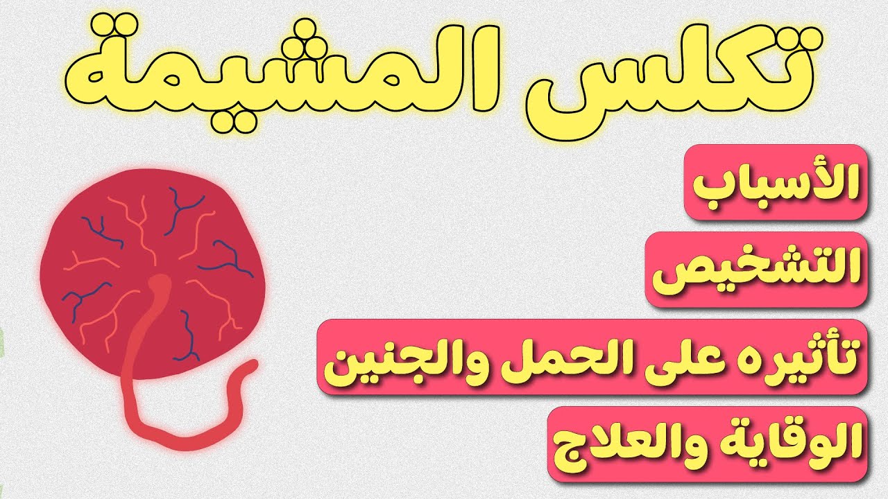 تكلس المشيمة - كل ما يجب أن تعرفه الحامل