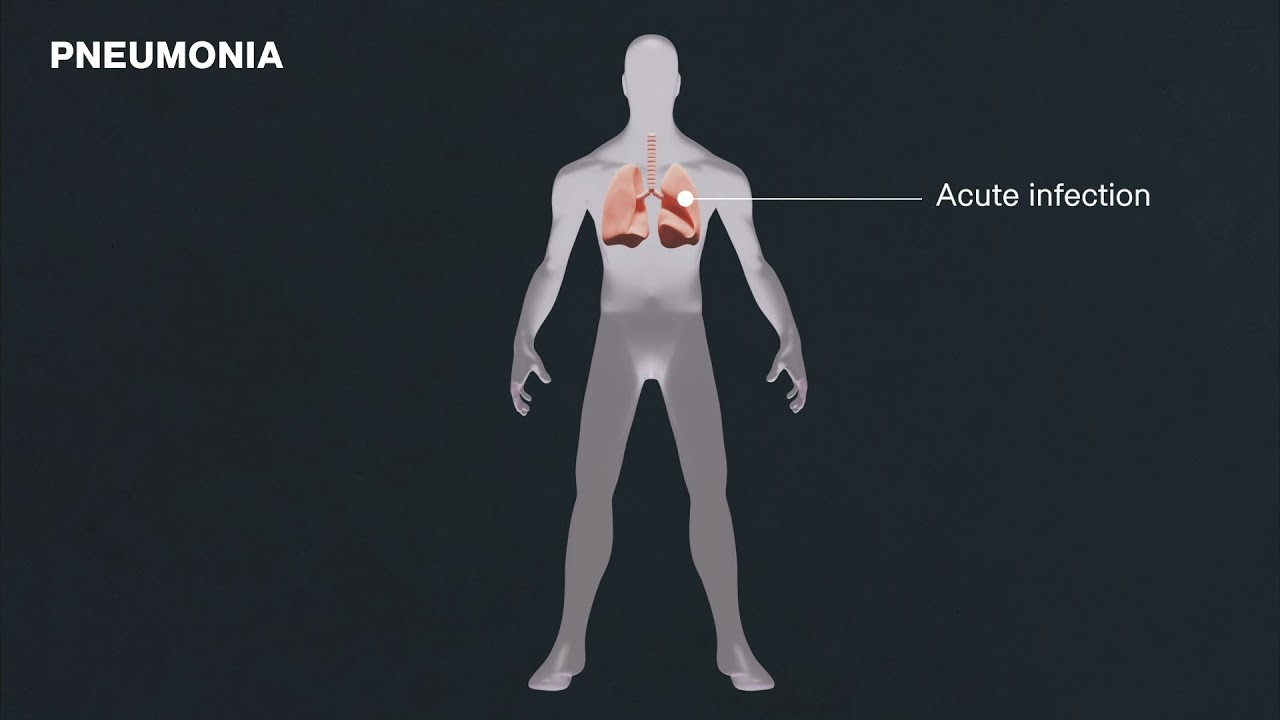 Genetic architecture of pneumonia susceptibility