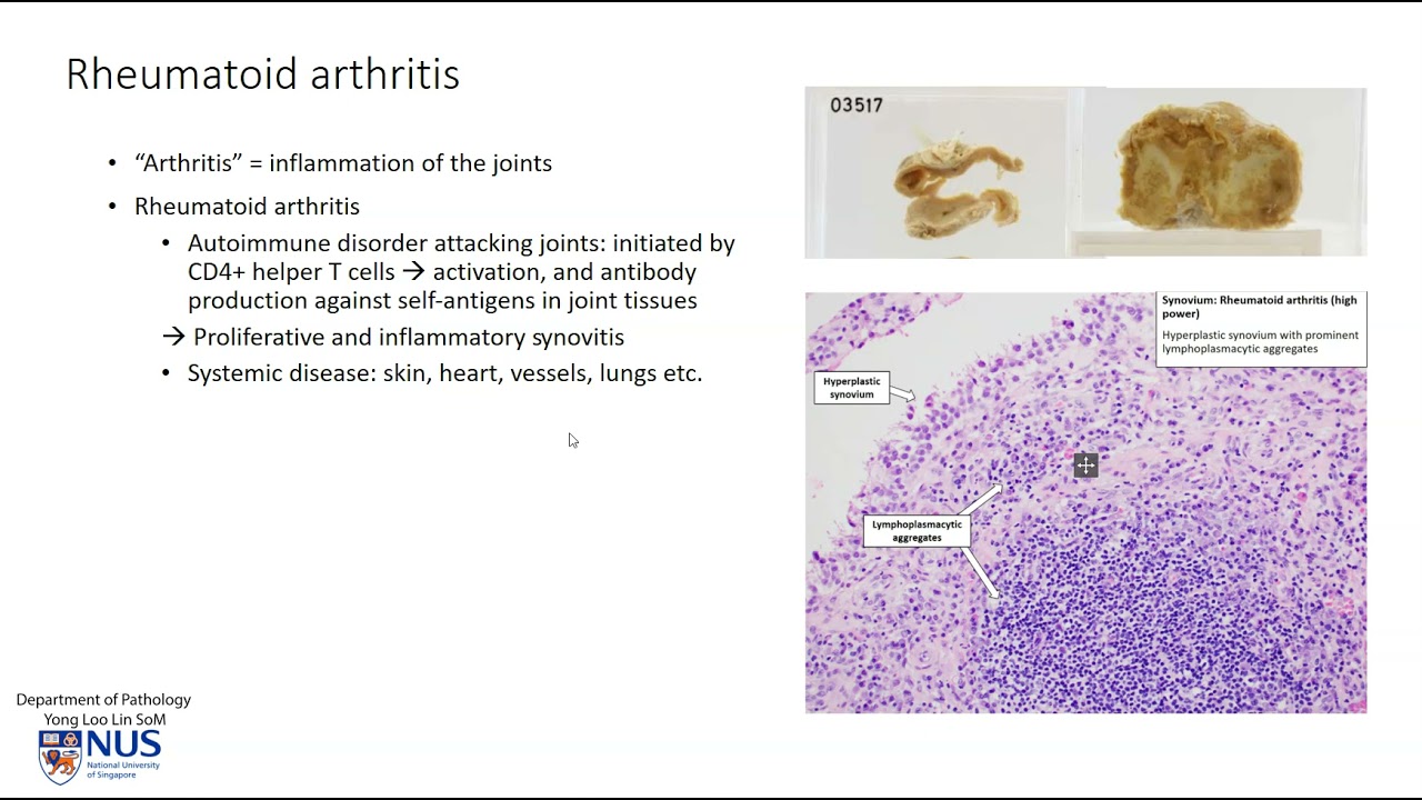 Tibia   Rheumatoid arthritis