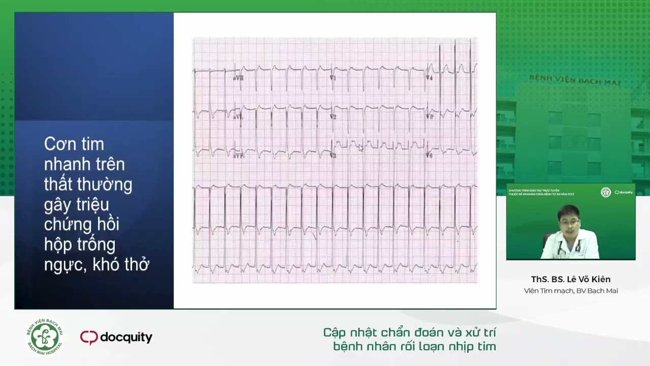 Cập nhật chẩn đoán và xử trí BN rối loạn nhịp tim