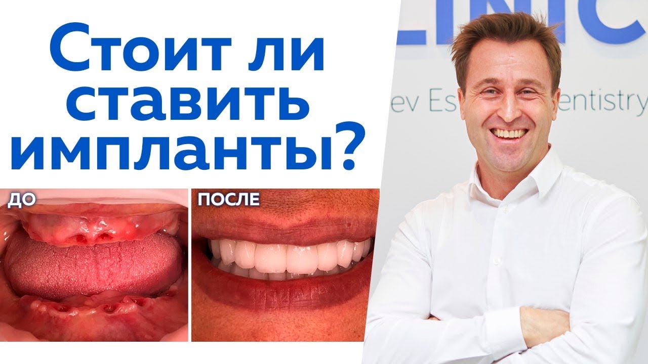 Как создать зуб взамен утраченного? / Всё, что нужно знать об имплантации