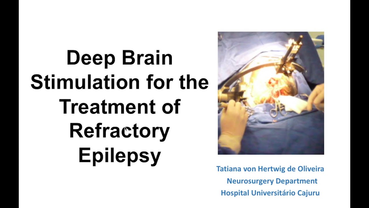 Deep brain stimulation for the treatment of refractory epilepsy: Anatomy, Technique, Complications