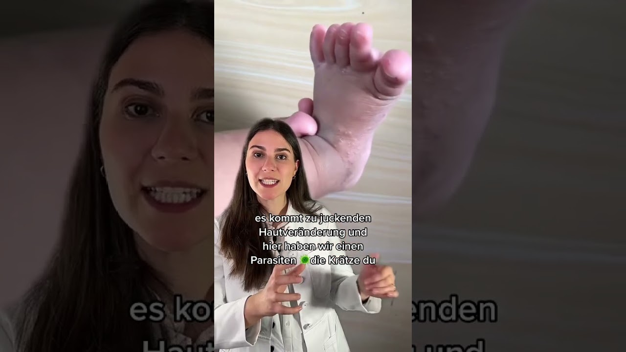 Kr&auml;tze ⚠️ So wird sie behandelt!